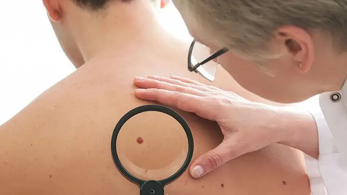 Vücutta Oluşan Benler Nasıl Geçer? Uzmanlar Uyarıyor