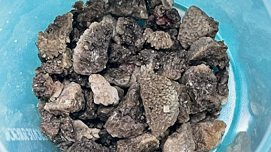 Malatya'da 8 Santimetrelik Dev Böbrek Taşı Kapalı Yöntemle Çıkarıldı