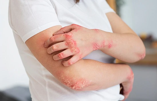 Sedef Hastalığı Nedir?