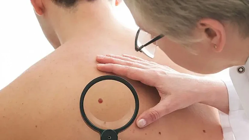 Vücutta Oluşan Benler Nasıl Geçer? Uzmanlar Uyarıyor